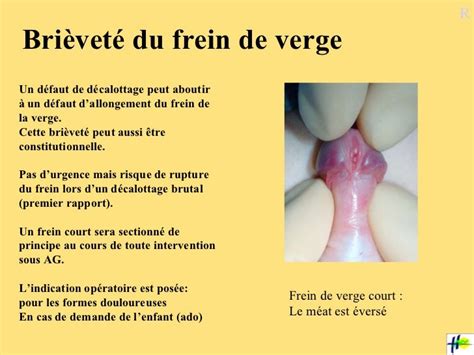 rupture du frein du prepuce|Rupture du frein du pénis : tout ce que vous devez savoir